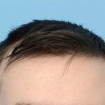 Fue Before and After | Dr. Jeffrey Wise