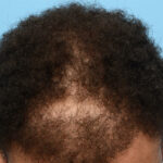 Fue Before and After | Dr. Jeffrey Wise