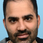 Fue Before and After | Dr. Jeffrey Wise