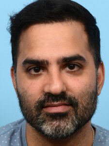 Fue Before and After | Dr. Jeffrey Wise