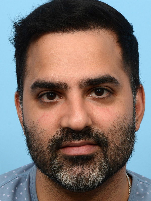 Fue Before and After | Dr. Jeffrey Wise