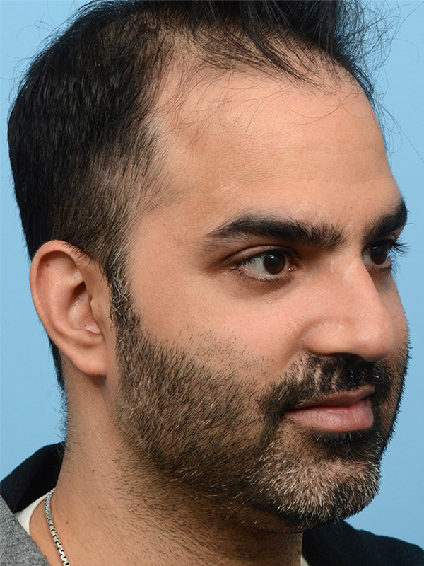 Fue Before and After | Dr. Jeffrey Wise