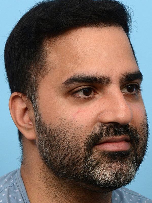 Fue Before and After | Dr. Jeffrey Wise
