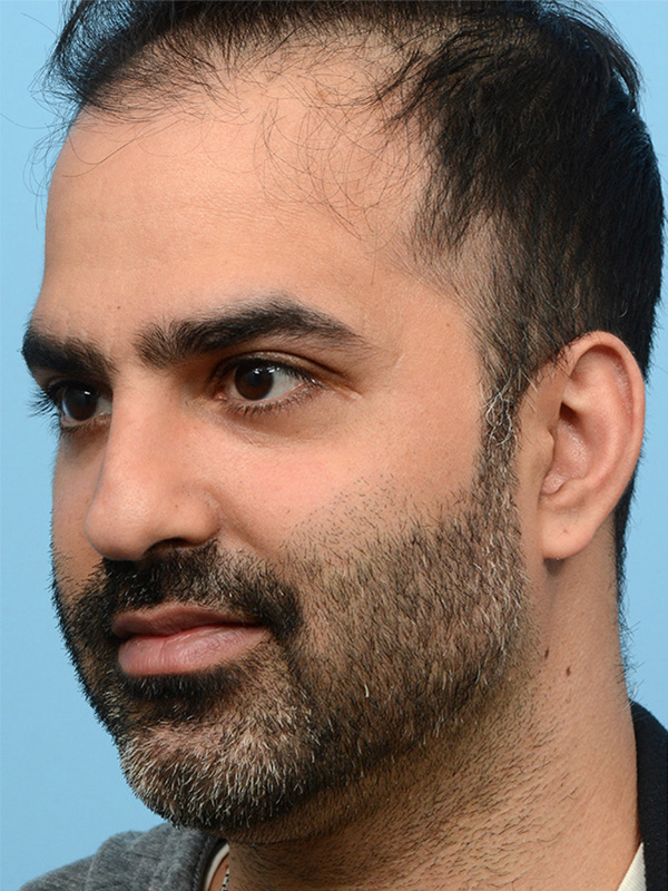 Fue Before and After | Dr. Jeffrey Wise