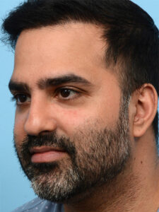 Fue Before and After | Dr. Jeffrey Wise