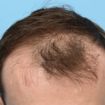 Fue Before and After | Dr. Jeffrey Wise