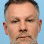 Fue Before and After | Dr. Jeffrey Wise