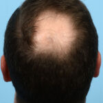 Fue Before and After | Dr. Jeffrey Wise
