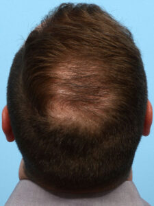 Fue Before and After | Dr. Jeffrey Wise