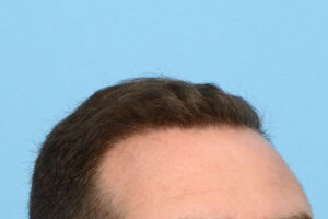 Fue Before and After | Dr. Jeffrey Wise