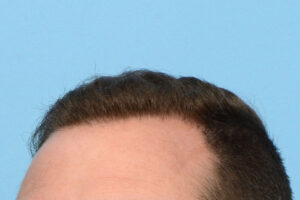 Fue Before and After | Dr. Jeffrey Wise