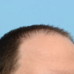 Fue Before and After | Dr. Jeffrey Wise