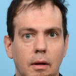 Fue Before and After | Dr. Jeffrey Wise