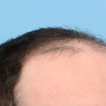 Fue Before and After | Dr. Jeffrey Wise
