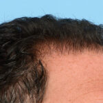 Fue Before and After | Dr. Jeffrey Wise