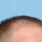 Fue Before and After | Dr. Jeffrey Wise