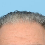 Fue Before and After | Dr. Jeffrey Wise