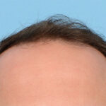 Fue Before and After | Dr. Jeffrey Wise