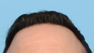 Fue Before and After | Dr. Jeffrey Wise