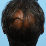 Fue Before and After | Dr. Jeffrey Wise