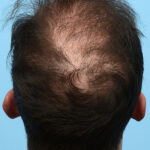 Fue Before and After | Dr. Jeffrey Wise