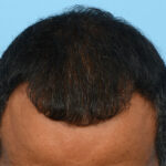 Fue Before and After | Dr. Jeffrey Wise