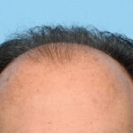 Fue Before and After | Dr. Jeffrey Wise