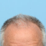 Fue Before and After | Dr. Jeffrey Wise