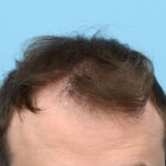 Fue Before and After | Dr. Jeffrey Wise