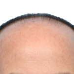 Fue Before and After | Dr. Jeffrey Wise