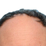 Fue Before and After | Dr. Jeffrey Wise