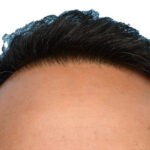 Fue Before and After | Dr. Jeffrey Wise