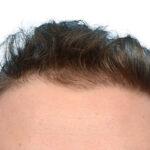 Fue Before and After | Dr. Jeffrey Wise
