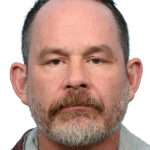 Fue Before and After | Dr. Jeffrey Wise