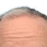 Fue Before and After | Dr. Jeffrey Wise