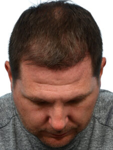 Fue Before and After | Dr. Jeffrey Wise
