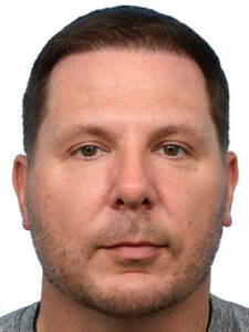 Fue Before and After | Dr. Jeffrey Wise