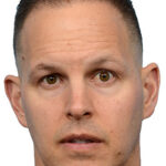 Fue Before and After | Dr. Jeffrey Wise