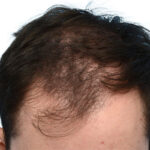Fue Before and After | Dr. Jeffrey Wise