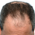 Fue Before and After | Dr. Jeffrey Wise