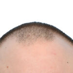 Fue Before and After | Dr. Jeffrey Wise