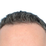 Fue Before and After | Dr. Jeffrey Wise