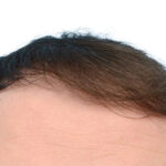 Fue Before and After | Dr. Jeffrey Wise