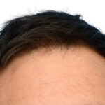 Fue Before and After | Dr. Jeffrey Wise