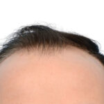 Fue Before and After | Dr. Jeffrey Wise