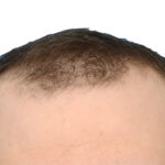 Fue Before and After | Dr. Jeffrey Wise