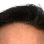 Fue Before and After | Dr. Jeffrey Wise
