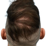 Fue Before and After | Dr. Jeffrey Wise