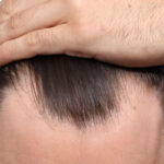 Fue Before and After | Dr. Jeffrey Wise