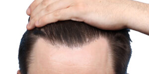 Fue Before and After | Dr. Jeffrey Wise
